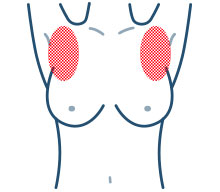 乳癌發生部位