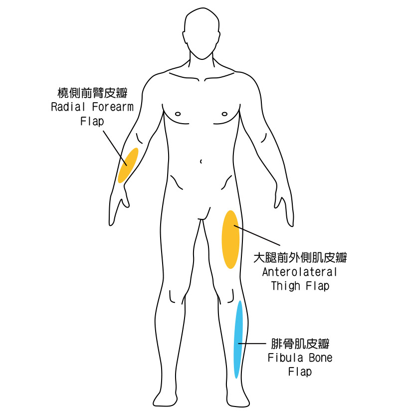 重建皮瓣分為三種 重建皮瓣分為三種