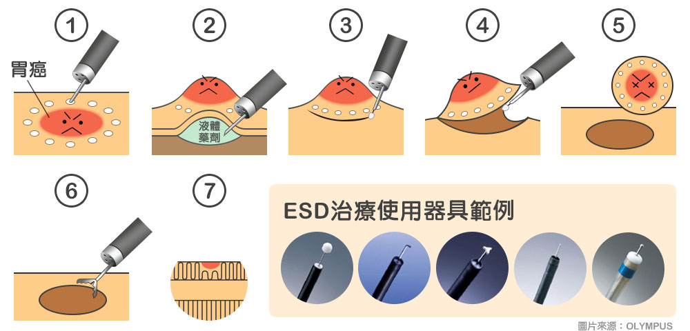ESD(內視鏡黏膜下剝離術)