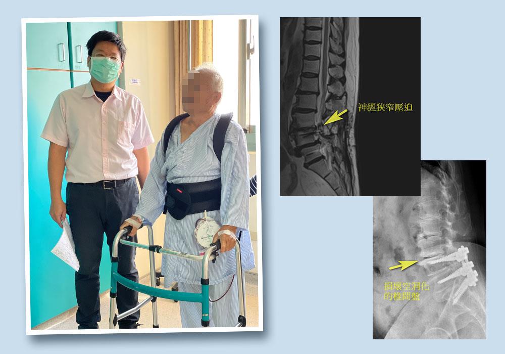 雙通道脊椎內視鏡微創翻修  治療高齡脊椎退化效果佳