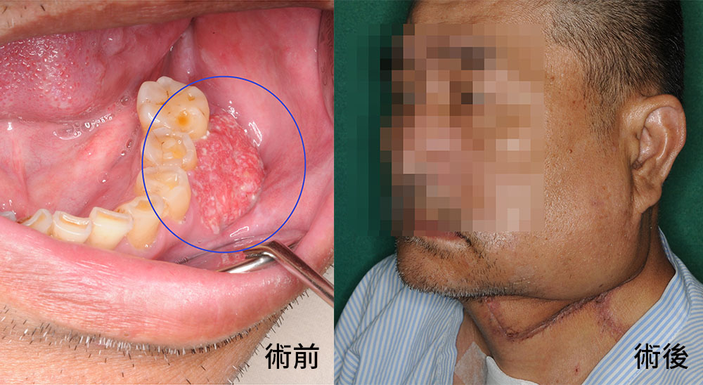 口腔保健莫遲疑,早日戒除菸酒檳