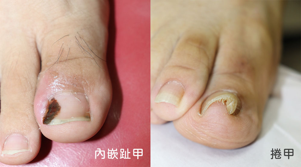 腳趾甲常長進肉裡怎麼辦?矯正治療讓您不再面臨拔趾甲恐懼