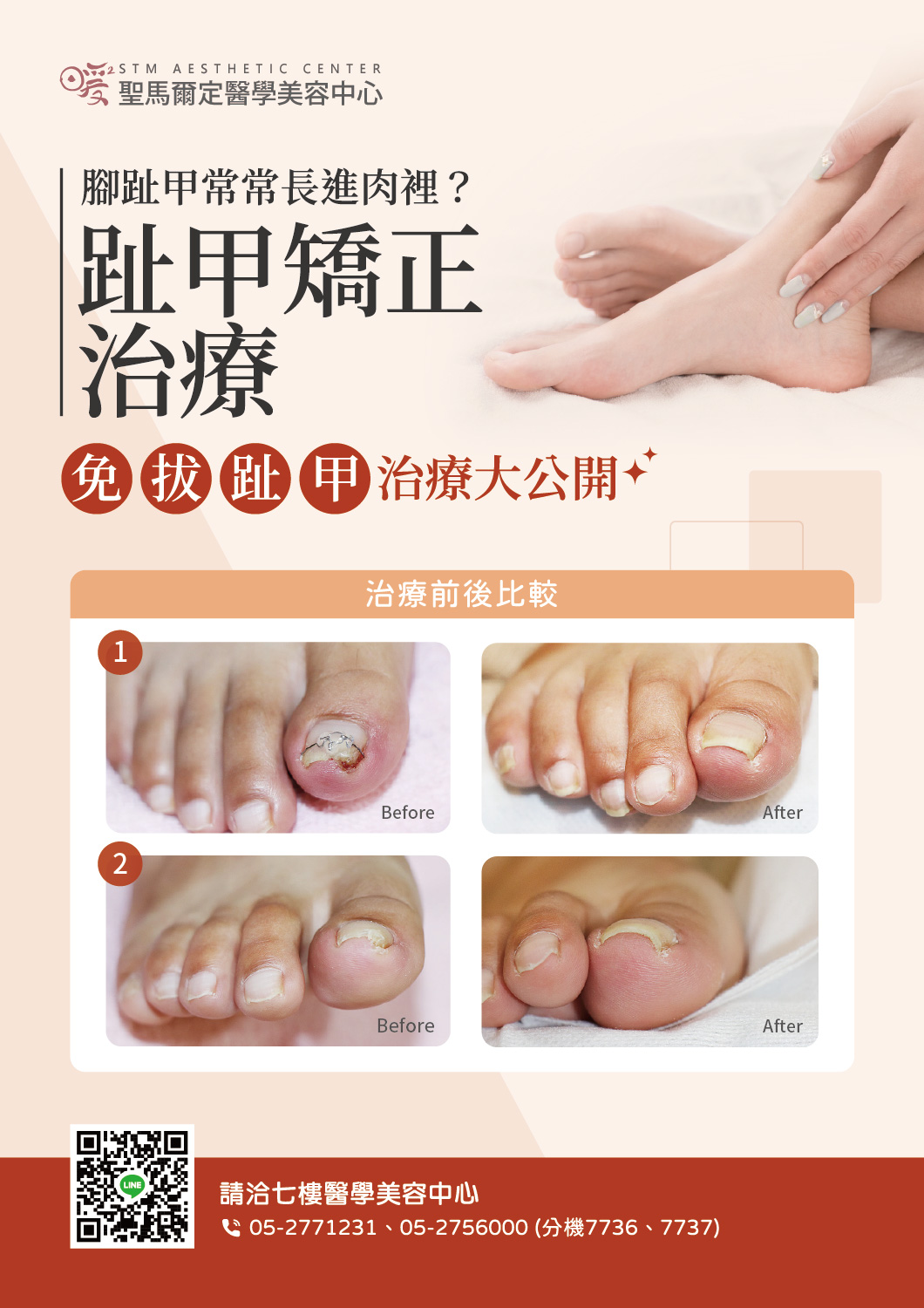 引進趾甲矯正最新治療，免除拔趾甲痛苦！