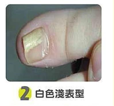 白色淺表型