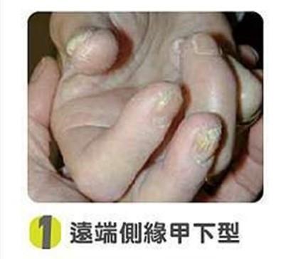遠端側緣甲下型