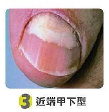 近端甲下型