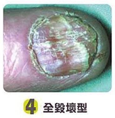 全毀壞型