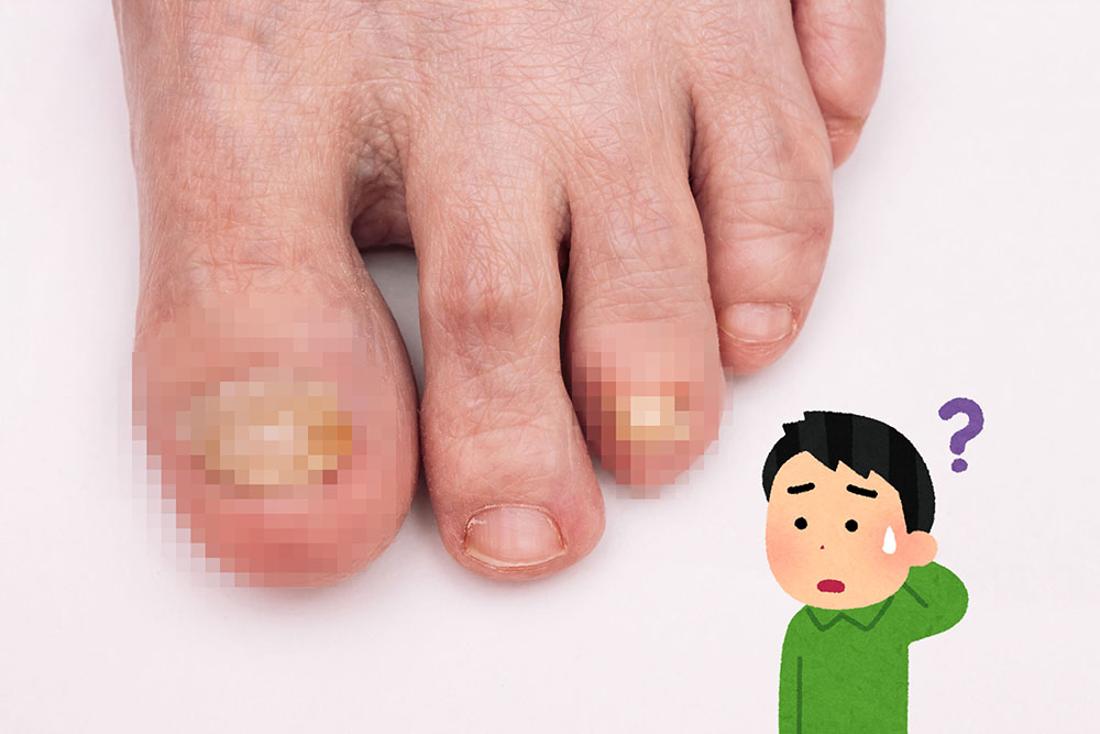 灰指甲不是灰色而是病! 認識灰指甲的治療